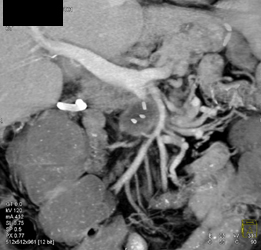 Recurrent Pancreatic Cancer Encases Superior Mesenteric Vein (SMV) - CTisus CT Scan