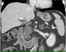 Intraductal Papillary Mucinous Neoplasm (IPMN) - CTisus CT Scan