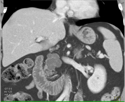 Intraductal Papillary Mucinous Neoplasm (IPMN) - CTisus CT Scan