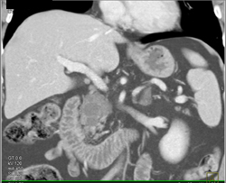 Intraductal Papillary Mucinous Neoplasm (IPMN) - CTisus CT Scan