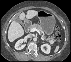 Insulinoma - CTisus CT Scan