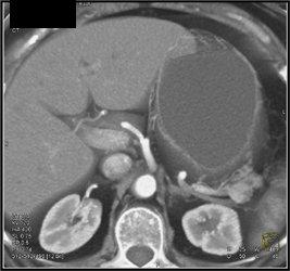 Insulinoma - CTisus CT Scan