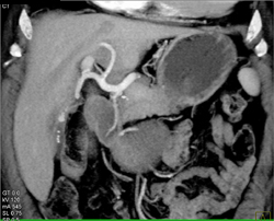 Chronic Pancreatitis - CTisus CT Scan