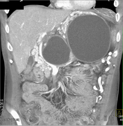 Pseudocyst With Collaterals - CTisus CT Scan