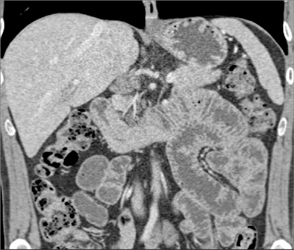 Duodenal Carcinoma - CTisus CT Scan