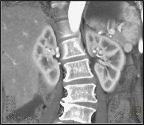 Accessory Spleen Vs Tail of Pancreas Mass - CTisus CT Scan