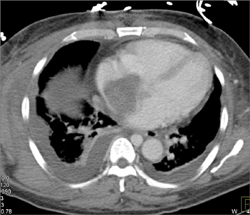 Tumor Extends Into Right Atrium - CTisus CT Scan