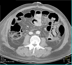 Infarcted Bowel S/P Whipple Disease - CTisus CT Scan