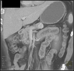 Islet Cell Tumor - CTisus CT Scan