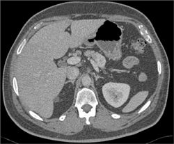 Islet Cell Tumor - CTisus CT Scan