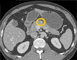 7 Mm Insulinoma - CTisus CT Scan