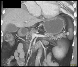 Accessory Spleen Near Tail of Pancreas - CTisus CT Scan