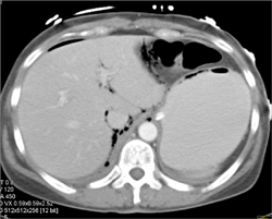 ERCP With Perforation and Abscess - CTisus CT Scan