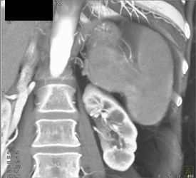 Carcinoma of the Tail of the Pancreas Invades the Spleen - CTisus CT Scan