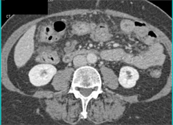 Carcinomatosis - CTisus CT Scan