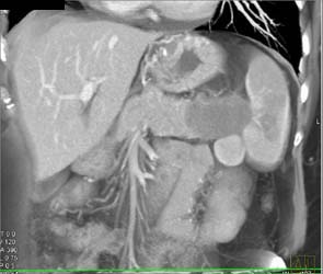 Carcinoma of the Tail of the Pancreas Causes Splenic Infarction - CTisus CT Scan