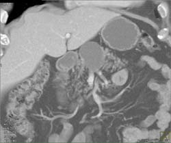 Cystadenoma - CTisus CT Scan