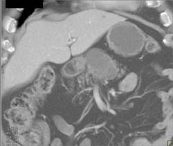 Cystadenoma - CTisus CT Scan