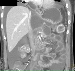 Pseudocysts Compress Inferior Vena Cava (IVC) - CTisus CT Scan