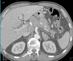 Pancreatic Cancer With Venous Encasement - CTisus CT Scan