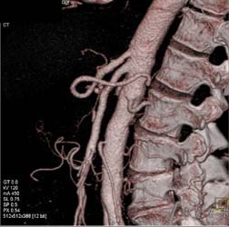 Patent SMA-celiac - CTisus CT Scan