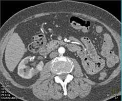 Recurrent Renal Cell Carcinoma Metastatic to the Pancreas - CTisus CT Scan