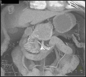 Cystadenoma - CTisus CT Scan