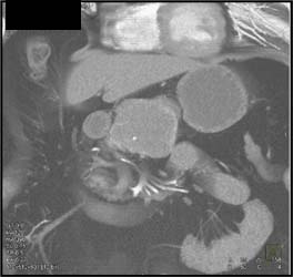 Cystadenoma - CTisus CT Scan