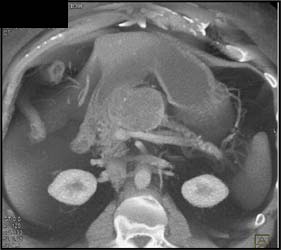 Cystadenoma - CTisus CT Scan