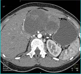 SPEN Or Hamoudi Tumor - CTisus CT Scan