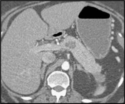 Intraductal Papillary Mucinous Neoplasm (IPMN) - CTisus CT Scan