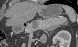 Intraductal Papillary Mucinous Neoplasm (IPMN) - CTisus CT Scan