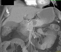 Intraductal Papillary Mucinous Neoplasm (IPMN) - CTisus CT Scan