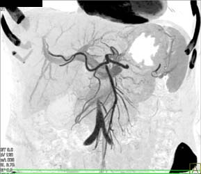 Pancreatic Head Mass Obstructs the Common Bile Duct (CBD) - CTisus CT Scan