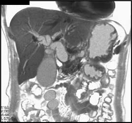 Double Duct Sign Without Vascular Invasion - CTisus CT Scan