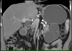 Cystic Lesion in Tail of Pancreas C/w Cystadenoma - CTisus CT Scan