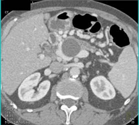 Intraductal Papillary Mucinous Neoplasm (IPMN) - CTisus CT Scan