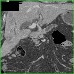 Pancreatic Cancer - CTisus CT Scan