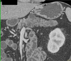 Adenocarcinoma of the Body of the Pancreas With Unusual Tail of Pancreas - CTisus CT Scan