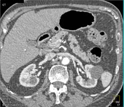 Focal Lipoma in the Pancreas - CTisus CT Scan