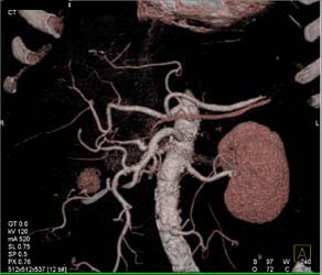 Normal Vasculature - CTisus CT Scan