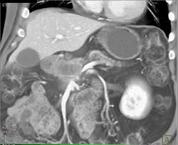 Pancreatic Cancer Invades the Superior Mesenteric Vein (SMV) - CTisus CT Scan