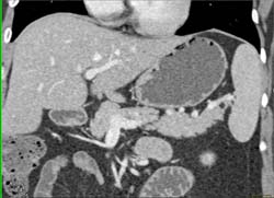 Lipoma in Tail of Pancreas - CTisus CT Scan