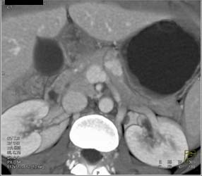 Insulinoma - CTisus CT Scan