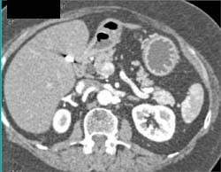 Insulinoma - CTisus CT Scan