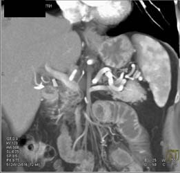 Insulinoma - CTisus CT Scan