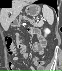 Insulinoma - CTisus CT Scan