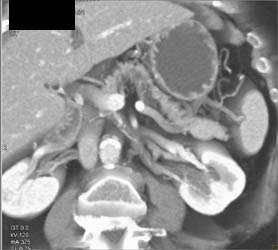 Insulinoma - CTisus CT Scan