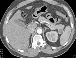 Intrapancreatic Splenic Tissue Simulates An Islet Cell - CTisus CT Scan