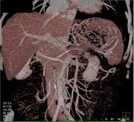 Occluded Splenic Vein - CTisus CT Scan